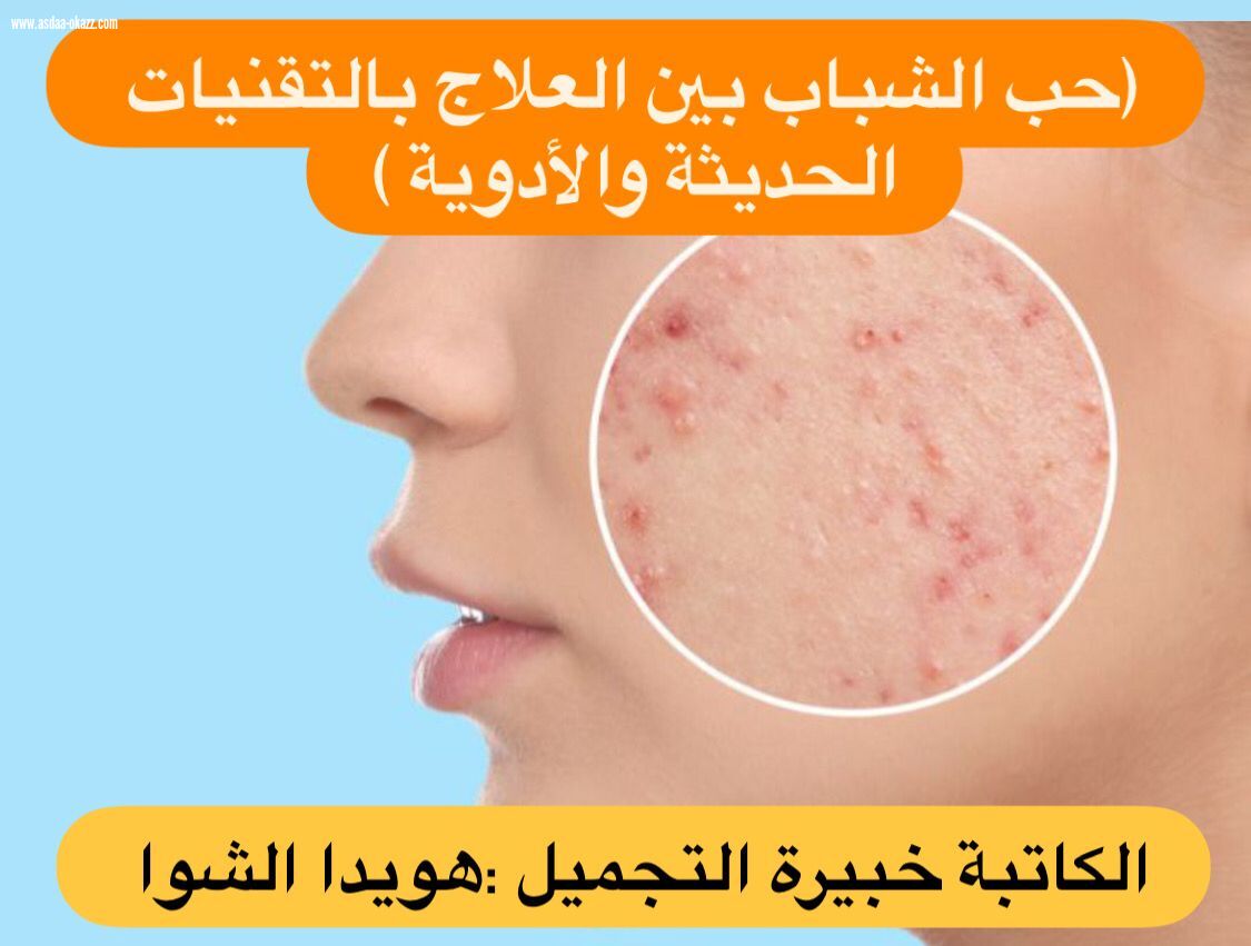 (حب الشباب بين العلاج بالتقنيات الحديثة والأدوية )