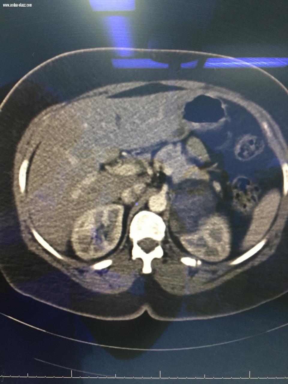 تم إكتشافه بالصدفة إثر حادث مروري منذ عامين فريق طبي ينجح في إستئصال ورم حميد لمواطنة  