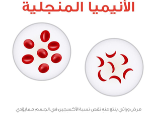 الانيميا المنجلية .